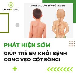 Giảm Nguy Cơ và Chăm Sóc Sức Khỏe Cột Sống Cho Trẻ - Bí Quyết Của Bones and Beyond Vietnam