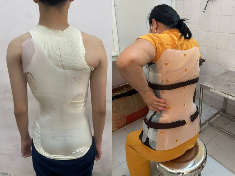 Các Loại Nẹp Vẹo Cột Sống Hiện Nay | Bones and Beyond