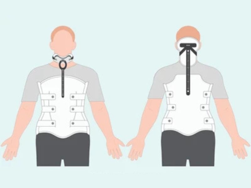 Nẹp Milwaukee (Milwaukee Brace)