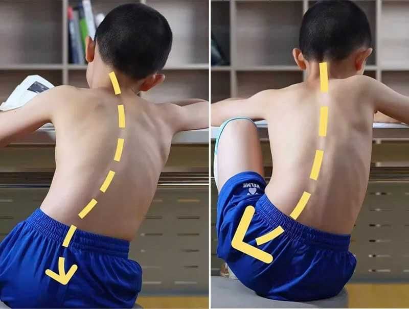 cong vẹo cột sống ở trẻ