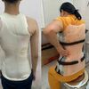 Các Loại Nẹp Vẹo Cột Sống Hiện Nay | Bones and Beyond