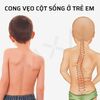 Cong vẹo cột sống ở trẻ em: Nguyên nhân, dấu hiệu và cách điều chỉnh hiệu quả