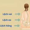 Khắc Phục Lệch Hông Khi Đứng, Đi Lại Bị Nghiêng Người: Nên Làm Gì?
