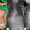 Vẹo Cột Sống Bẩm Sinh Có Chữa Được Không? | Bones and Beyond