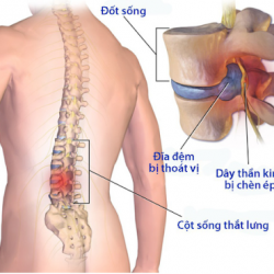 Vẹo cột sống thoát vị đĩa đệm là gì? Có thể phòng chống được hay không?