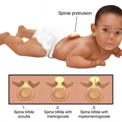 Cách khắc phục tình trạng cong vẹo cột sống trẻ sơ sinh