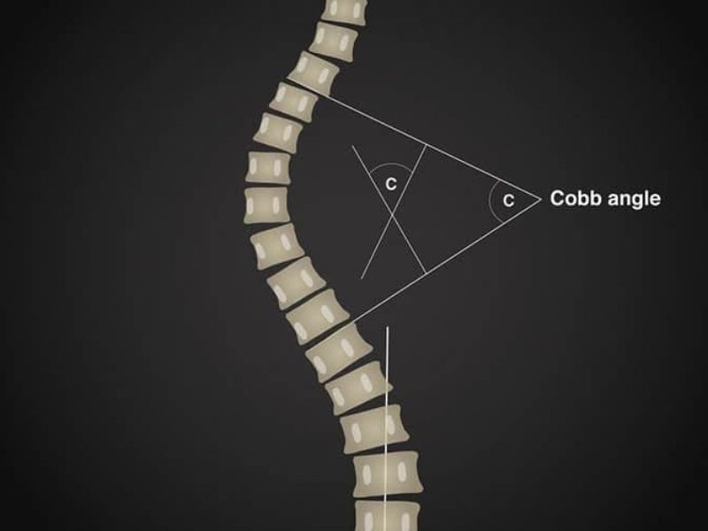 Bảng Phân Loại Mức Độ Cong Cột Sống Theo Góc Cobb