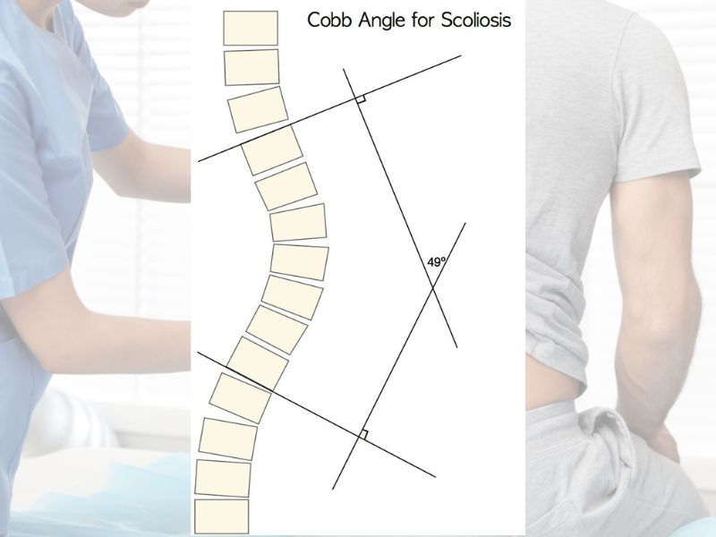 Chỉ Số Cobb Là Gì? Cách Đo Độ Cong Cột Sống Chuẩn Y Khoa