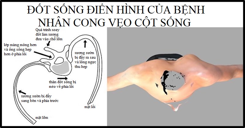 Đốt sống ngực của bệnh nhân cong vẹo cột sống