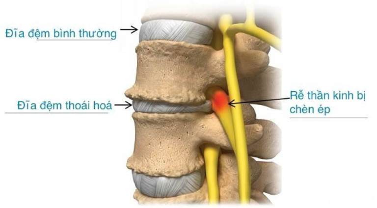 Thoái hóa đĩa đệm