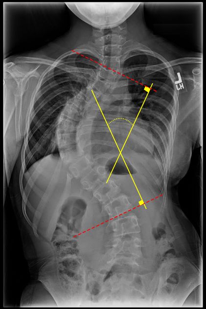 cobb-angle-_-radiology-reference-article-_-radiopaedia_org