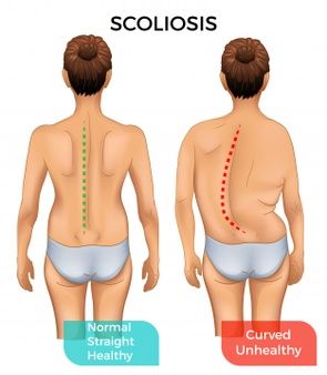 columna-vertebral-sana-normal-y-columna-curva-con-escoliosis_