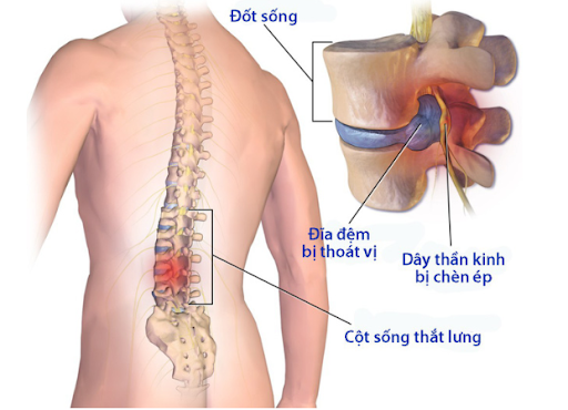 Vẹo cột sống thoát vị đĩa đệm là gì? Có thể phòng chống được hay không?