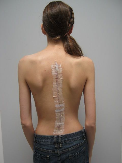 scoliosis-surgery-recovery---right-angle-girl