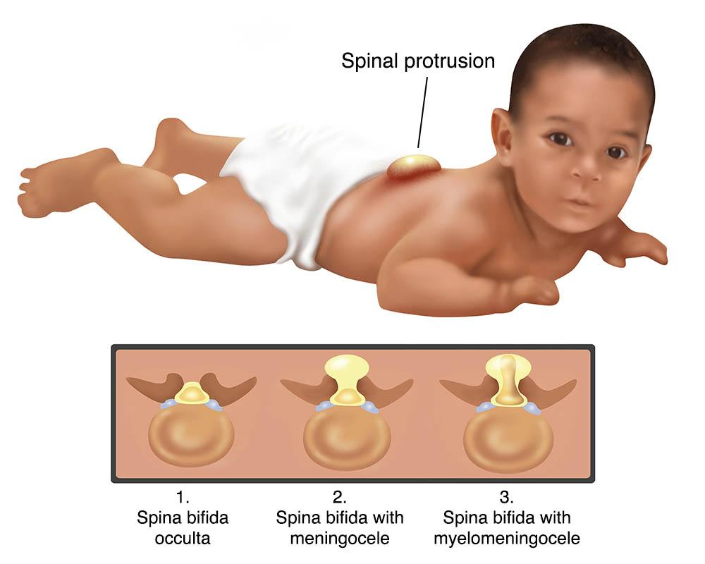 Cách khắc phục tình trạng cong vẹo cột sống trẻ sơ sinh