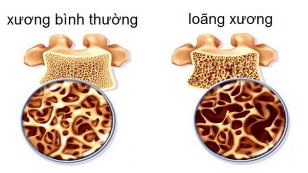 Xương bình thường và loãng xương