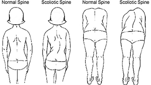 Cách nhận biết cong vẹo cột sống