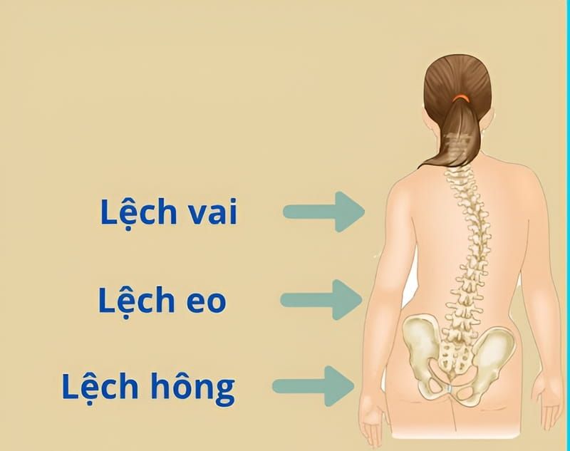 Khắc Phục Lệch Hông Khi Đứng, Đi Lại Bị Nghiêng Người: Nên Làm Gì?