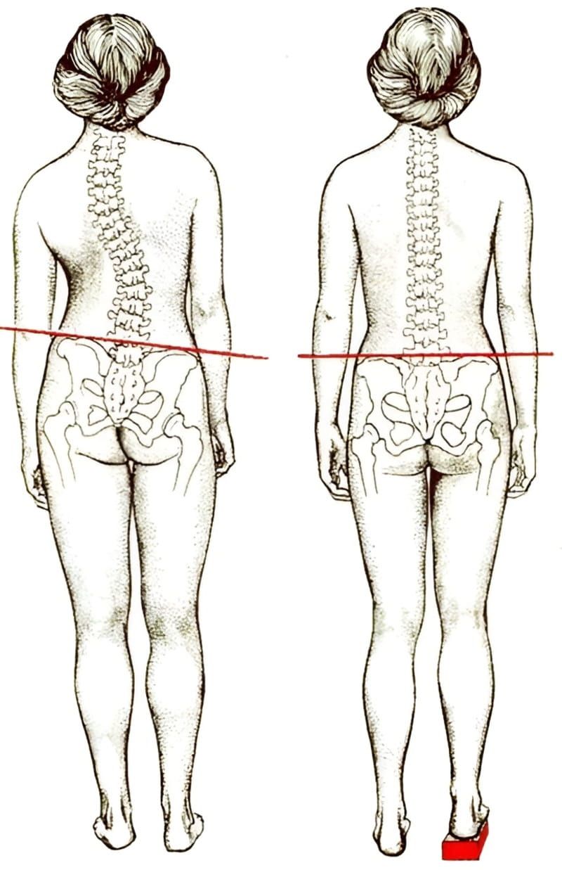 Khắc phục lệch hông
