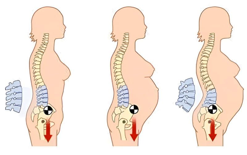 Người bị cong vẹo cột sống mang thai: Khi nào an toàn, khi nào nên cân nhắc?