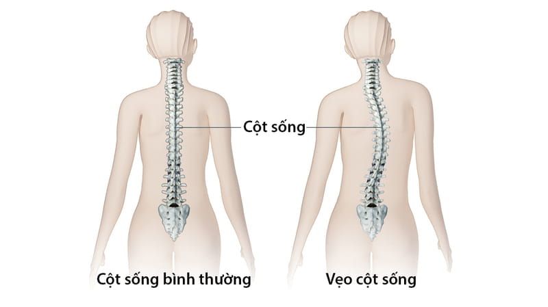 So Sánh CLEAR Và Schroth Trong Điều Trị Vẹo Cột Sống Không Phẫu Thuật