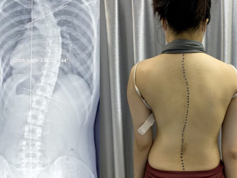 Trẻ Bị Cong Vẹo Cột Sống: Nhận Biết Sớm, Điều Trị Đúng