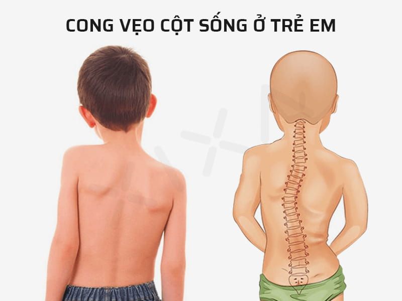 trẻ em ngồi cong lưng