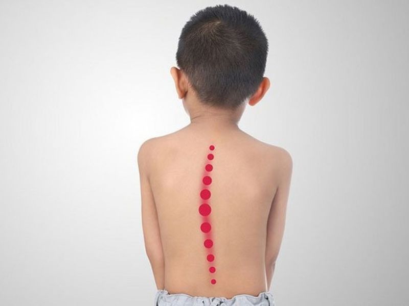 Vẹo Cột Sống 25 Độ Là Gì? Thuộc Mức Độ Nhẹ Hay Trung Bình?