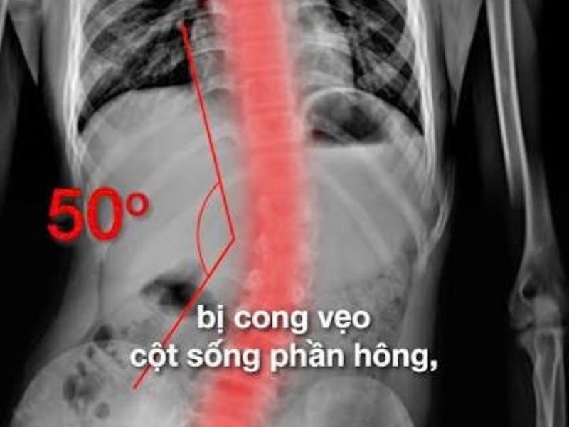 Vẹo Cột Sống 50 Độ Là Gì? Thuộc Mức Độ Nào Theo Góc Cobb?