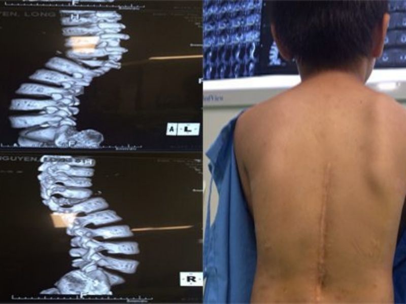 Chẩn Đoán Vẹo Cột Sống Bẩm Sinh Như Thế Nào?