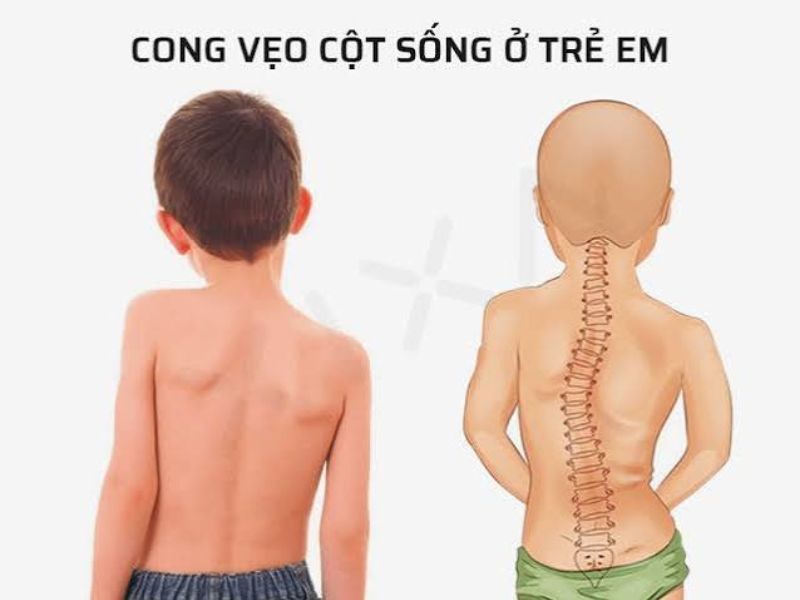 Dấu Hiệu Nhận Biết Vẹo Cột Sống Bẩm Sinh