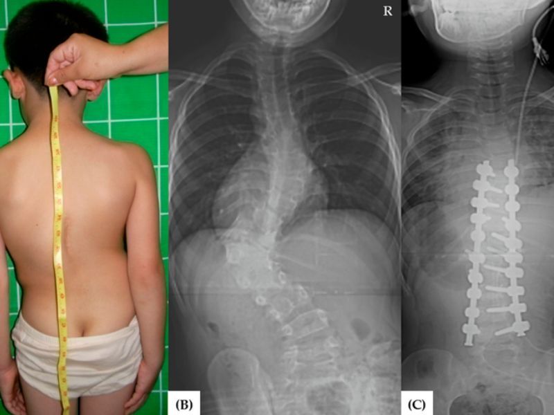 Vẹo Cột Sống Bẩm Sinh Có Chữa Được Không? | Bones and Beyond