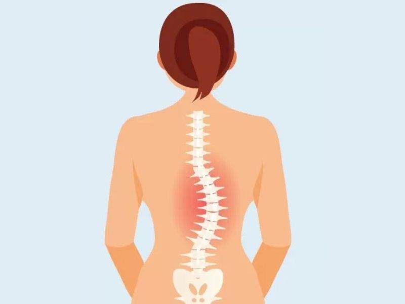 Vẹo Cột Sống Chữ C: Dấu Hiệu Nhận Biết Và Cách Điều Trị Hiệu Quả