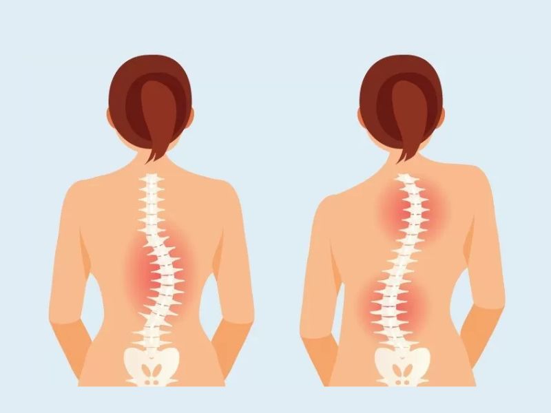 Vẹo Cột Sống Có Chữa Được Không? Câu Trả Lời Từ Chuyên Môn